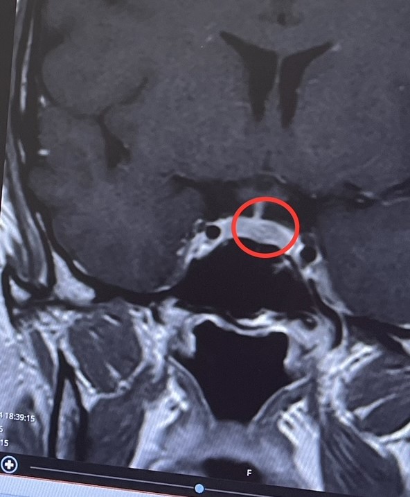 An MRI scan photo showing Sophie's pituitary tumour